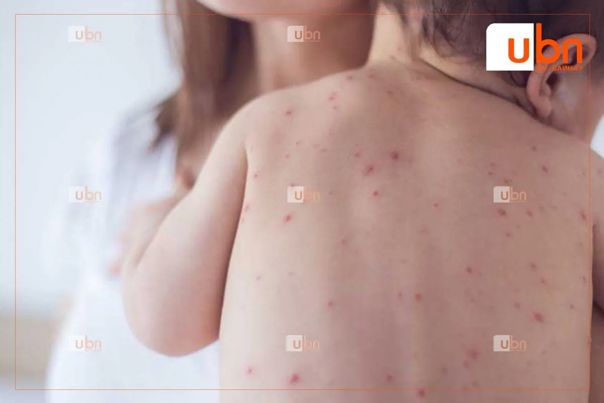 Улаанбурхан өвчнөөр 0-4 насны 2446 хүүхэд өвджээ
