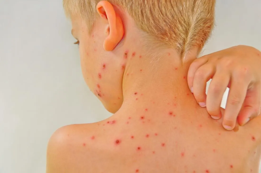 legacy:hereglesen zurag/chickenpox-back.jpg