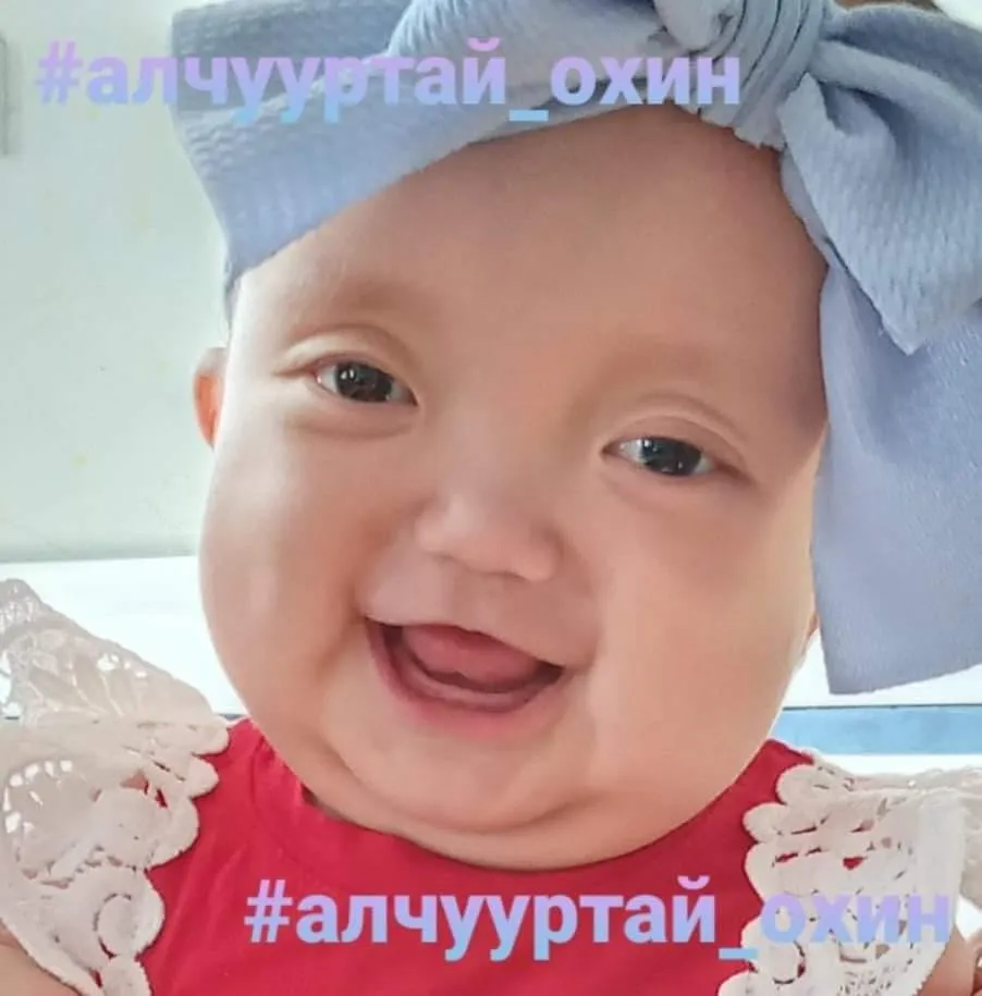 Алчууртай охины хагалгаа амжилттай болжээ